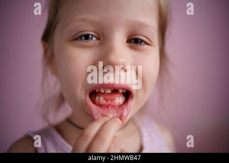 la ragazza sorride senza un dente anteriore Foto Stock