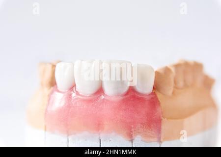 Dentiera di ceramica si trova sul modello in gesso Foto Stock