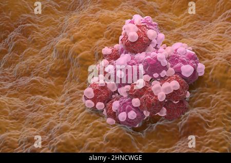 Gruppo di variazioni delle cellule tumorali ovariche - vista isometrica 3D illustrazione Foto Stock