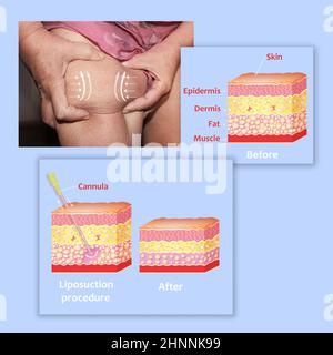 Meccanismo di liposuzione. Liposuzione assistita da aspirazione. Foto Stock