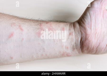 Campione di dermatite da contatto allergenica - eruzione cutanea rosa sul lato interno dell'avambraccio da vicino Foto Stock