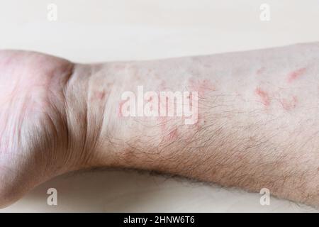 Campione di dermatite allergica da contatto - rash sul lato interno dell'avambraccio da vicino Foto Stock