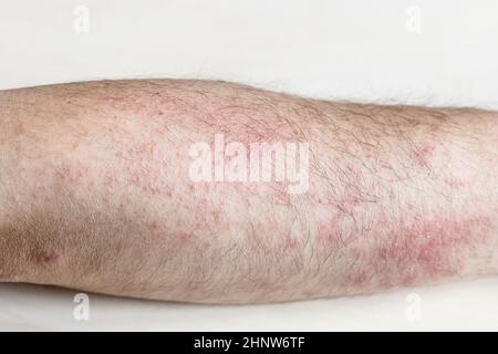 Campione di dermatite allergica da contatto - rash all'avambraccio esterno in primo piano Foto Stock