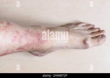 Campione di dermatite da contatto allergica - shin maschile con arrossamento ed eruzione cutanea pruriginosa sulla pelle Foto Stock