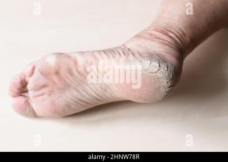pelle screpolata ruvida sul tallone del piede maschio in primo piano Foto Stock