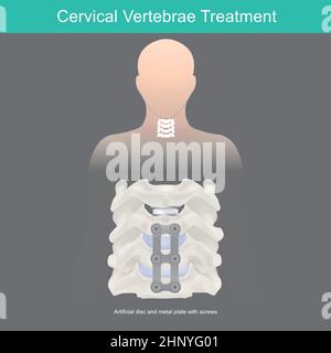 Trattamento delle vertebre cervicali. Anatomia ossea del collo e sostituzione artificiale del disco. Illustrazione Vettoriale