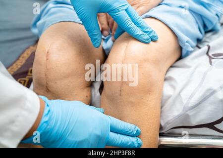Asian senior o anziani old Lady Donna paziente mostra le proprie cicatrici chirurgiche del ginocchio totale sostituzione della giuntura filo di sutura della ferita di artroplastica di chirurgia sul letto in nursin Foto Stock