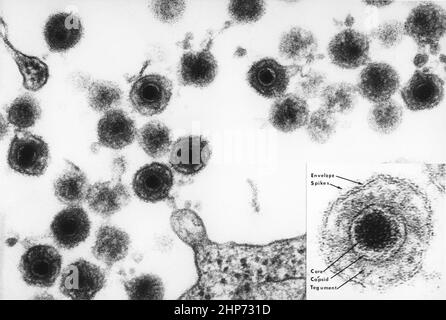 Una micrografia elettronica di HHV-6 include anche un inserto marcato della particella di virus matura. L'HHV-6 è un virus a DNA a doppio filamento della famiglia dell'herpes. Le particelle virali qui mostrate sono maturate e vengono quindi rilasciate dal linfocita che è stato infettato. L'aspetto dell'occhio del gufo delle particelle del virus è caratteristico della famiglia dell'herpes. Si pensava che l'HHV-6, o il virus dell'herpes umano-6, infettasse le cellule b ed era un tempo chiamato HBLV, virus B-linfotropico umano. CA. Ottobre 1986 Foto Stock