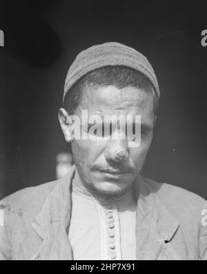 Storia del Medio Oriente: Un uomo che soffre di un pulsante Gerico o leishmaniosi cutanea ca. 1917 Foto Stock