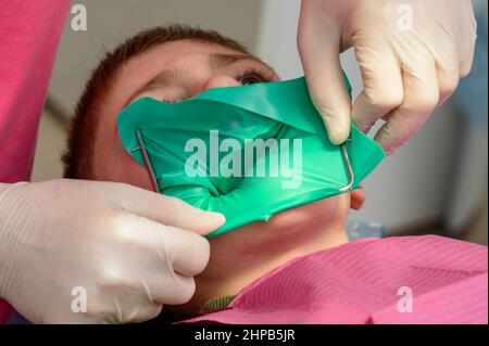 Il dentista installa una diga di gomma e un morsetto per il trattamento di un dente malato, il ragazzo è seduto in una sedia dentale. Foto Stock