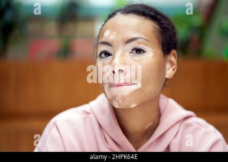 Donna nera afroamericana con pigmentazione vitiligina problema della pelle interna felpa con cappuccio rosa vestita primo piano ritratto pensivo nero pensiero femminile informazioni su Foto Stock