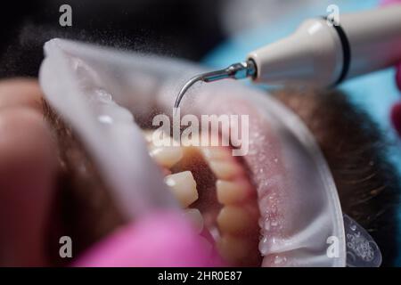 Fotografia macro. Vista dall'alto del processo di pulizia nella bocca del paziente. Pulizia dei denti con getto d'acqua ed espulsore di saliva. Divaricatore guancia sulla bocca. Co Foto Stock