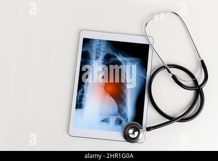Una compressa con una radiografia di un polmone e uno stetoscopio su un tavolo in un ospedale Foto Stock