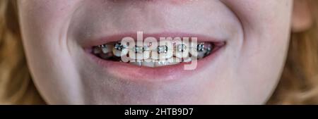 Vista in primo piano dei denti con rinforzi dentali sulla fila superiore. Bambino sorridente. Foto Stock