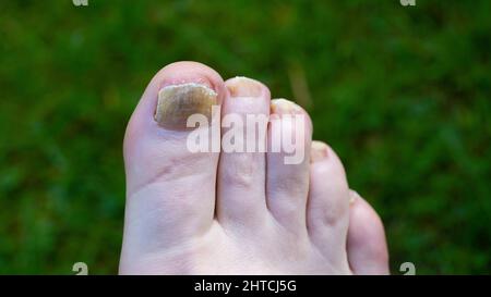 Toenail Fungus che mostra sulla punta grande Foto Stock