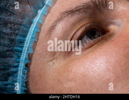 Una cicatrice profonda sul viso della ragazza vicino all'occhio. Concetto per rimuovere le cicatrici in cosmetologia utilizzando il ripurfacing laser Foto Stock