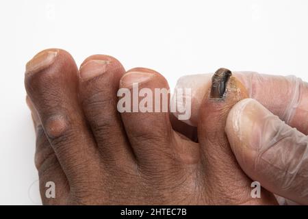 Toenail annerito distrutto da malattia fungina. Foto Stock