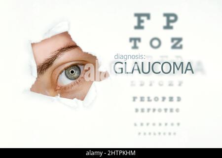 Poster della malattia di glaucoma con occhio di prova e occhio blu a sinistra. Isolato su bianco Foto Stock