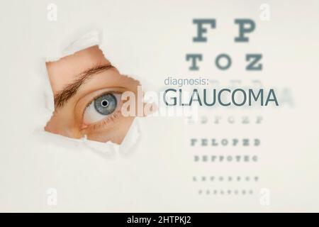 Poster della malattia di glaucoma con occhio di prova e occhio blu a destra. Sfondo grigio studio Foto Stock