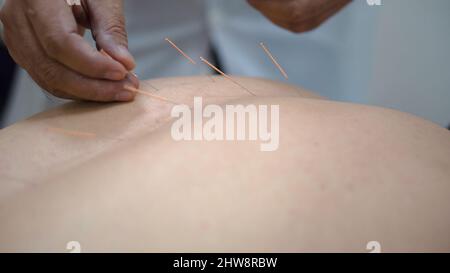 Agopuntura. Primo piano della schiena dell'uomo con gli aghi bloccati. Medicina cinese con agopuntura. L'uomo recupera la salute al massaggiatore professionista sulla m cinese Foto Stock