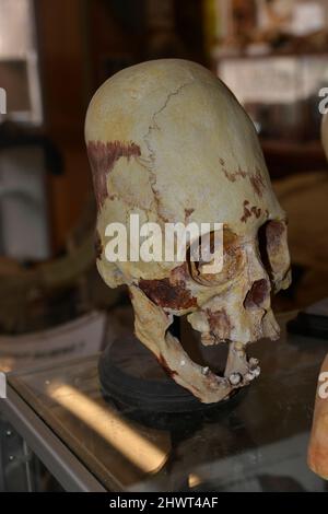 La deformazione intenzionale del cranio è stata eseguita in culture antiche di tutto il mondo. E 'stato fatto sui bambini per motivi sociali dalle culture antiche. Foto Stock