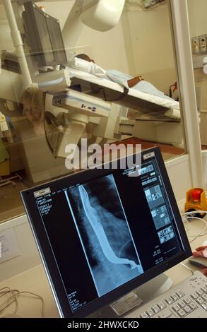 Pasto al bario, procedura in cui vengono eseguite radiografie dell'esofago, dello stomaco e del duodeno dopo l'ingestione del solfato di bario da parte di un paziente. Bario m Foto Stock