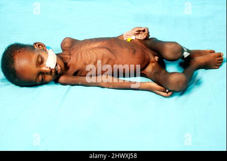 Un ragazzo di 2 anni che soffre di malnutrizione grave con grave spreco e perdita di grasso di subcutano (modello rilasciato) Foto Stock