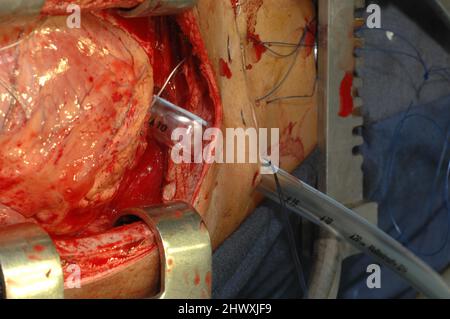 La sostituzione della valvola mitrale è una procedura chirurgica cardiaca in cui la valvola mitrale malata di un paziente viene sostituita da una protesi meccanica o bioprotetea Foto Stock