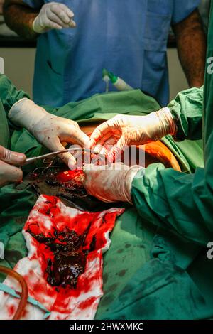 Un chirurgo esegue una sezione cesarea per rimuovere un feto di aborto spontaneo (aborto spontaneo) nell'utero del paziente. Non è noto perché l'attrezzo mot Foto Stock