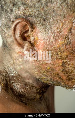 Un giovane che soffre di grave psoriasi ha anche sviluppato una qualche forma di infezione della pelle. Molti pazienti con sintomi dermatologici spesso si manifestano Foto Stock