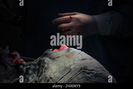 (Nota dei redattori l'immagine contiene contenuti grafici) Un medico palestinese nella striscia di Gaza esegue un intervento di plastica sul naso di patientís. Le cliniche di chirurgia cosmetica sono diventate popolari dappertutto la striscia. Foto Stock