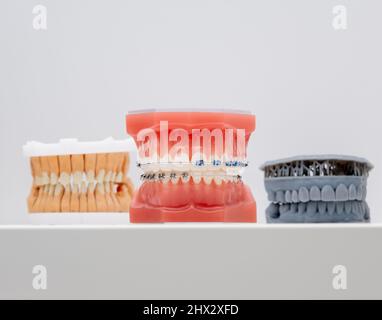 Rinforzi in metallo e ceramica sui denti di un primo piano artificiale delle mandibole. Bretelle su denti artificiali primo piano, odontoiatria dentale. Modello Jaw per la visualizzazione di un Foto Stock