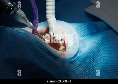 Vista dall'alto del processo di spazzolatura dei denti del paziente. Pulizia dei denti con getto d'acqua ed eiettore della saliva. Riavvolgitore guancia sui labbri. Il concetto di pro Foto Stock