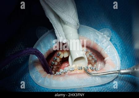 Vista dall'alto del processo di spazzolatura dei denti del paziente. Pulizia dei denti con getto d'acqua ed eiettore della saliva. Riavvolgitore guancia sui labbri. Il concetto di pro Foto Stock