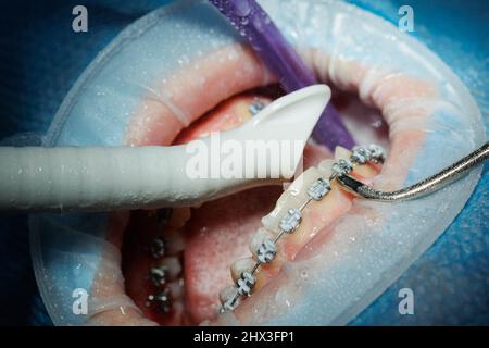 Vista dall'alto del processo di spazzolatura dei denti del paziente. Pulizia dei denti con getto d'acqua ed eiettore della saliva. Riavvolgitore guancia sui labbri. Il concetto di pro Foto Stock