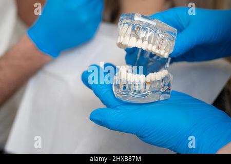 l'impiantista dentista mostra ad un paziente una mandibola con impianti e corone di impiallacciatura, impiantologia in odontoiatria, un campione di una mandibola di plastica con denti bianchi Foto Stock