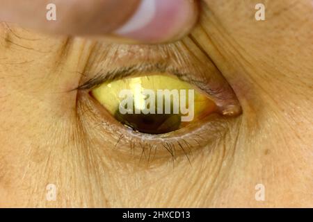 Ittero profondo in pazienti asiatici maschi. Colorazione giallastra della pelle e della sclera. Iperbilirubinemia. Epatite acuta. Foto Stock