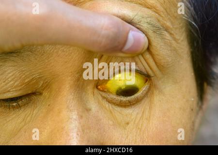 Ittero profondo in pazienti asiatici maschi. Colorazione giallastra della pelle e della sclera. Iperbilirubinemia. Epatite acuta. Foto Stock