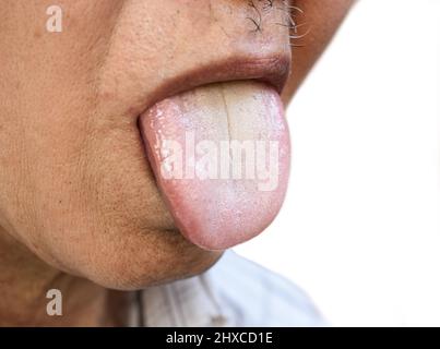 Lingua rivestita o lingua bianca dell'uomo asiatico, cinese. Appare con uno strato bianco quando detriti, batteri e cellule morte si depositano tra p ingrossato Foto Stock