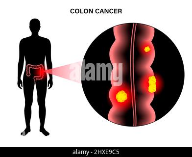 Cancro colorettale, illustrazione Foto Stock