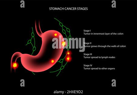 Il cancro dello stomaco, illustrazione Foto Stock