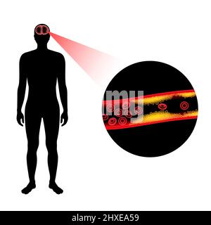 Ictus ischemico, illustrazione Foto Stock