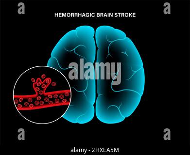 Ictus emorragico, illustrazione Foto Stock