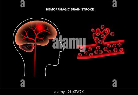 Ictus emorragico, illustrazione Foto Stock