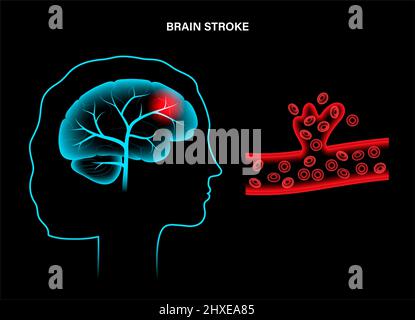 Ictus emorragico, illustrazione Foto Stock