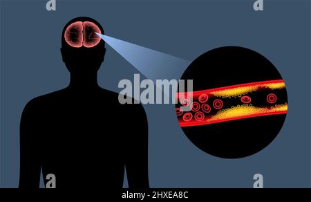 Ictus ischemico, illustrazione Foto Stock