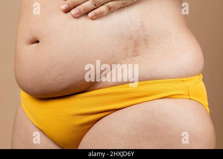 Foto croppata di grasso in sovrappeso donna incinta mano sul ventre, ombelico in pantaloni gialli, con strie stretch marks. Collagene Foto Stock