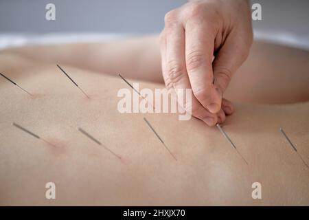 L'agopunturist corto tratta la malattia della paziente femminile con agopuntura in punti speciali sulla spina dorsale. L'agopuntura è medicina alternativa, t sano Foto Stock