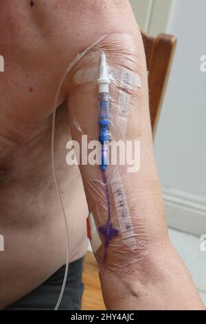 Uomo in trattamento con cloruro di sodio Fluorouracil farmaco citotossico per infusione endovenosa continua chemioterapia farmaco a casa attraverso Picc Line in braccio superiore - trattamento per il cancro Surrey Inghilterra Foto Stock