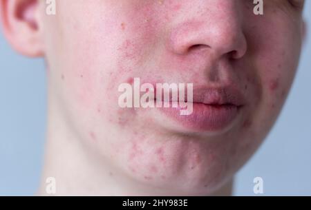 Un'immagine dell'acne sulla faccia di un adolescente . Pimples, cicatrici rosse e puntini neri su guance e mento. Il concetto di problema pelle, cura e bellezza. Foto Stock